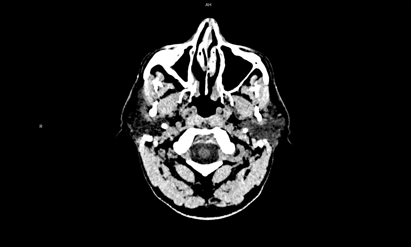 2D CT Scan